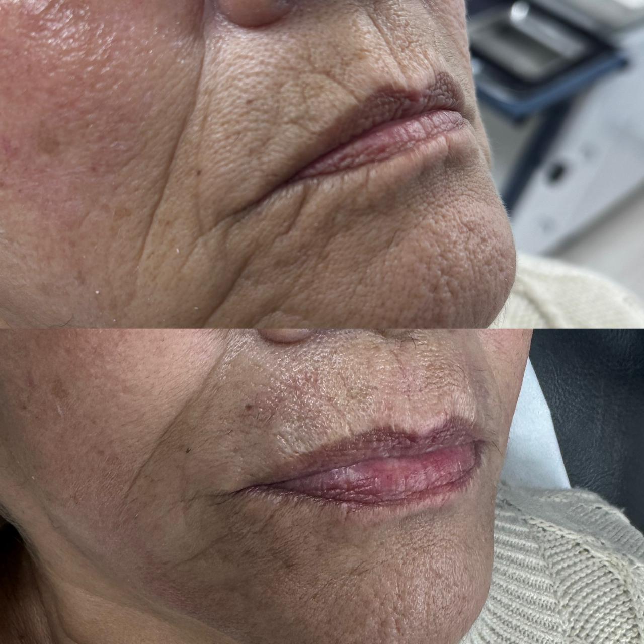 antes y despues CG STYLER SURCO NASOGENIANO 3